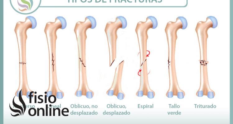 Fracturas óseas, tipos, cuidados y tratamiento