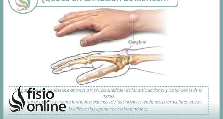 Conoce qué es, por qué se produce y cómo se trata el ganglión de muñeca o muñeca abierta Conoce qué es, por qué se produce y cómo se trata el ganglión de muñeca o muñeca abierta