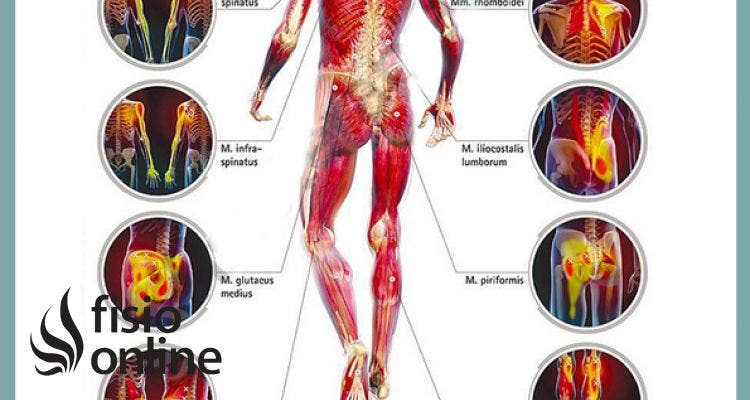 Puntos gatillo de la zona dorsal, los causantes musculares de la dorsalgia