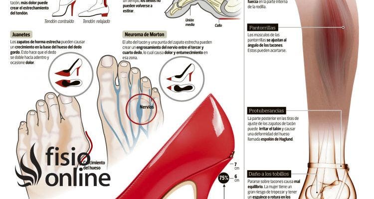 Consecuencias del abuso de los tacones. Daños en el tendón de Aquiles, juanetes, dedo martillo, neuroma de Morton