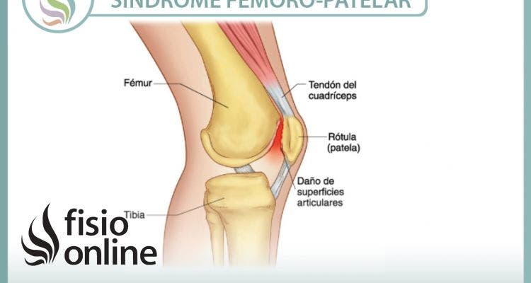 Tratamiento, características, síntomas, causas y mucho mas, sobre el síndrome femoro-patelar