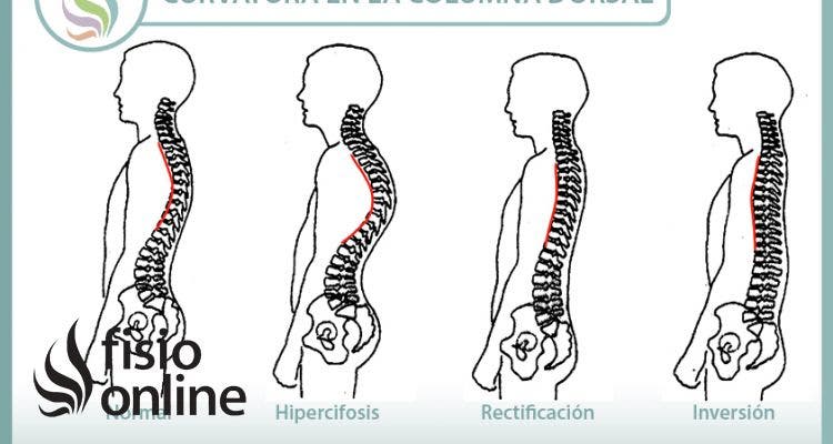 Hipercifosis, aprende que es y como corregirla