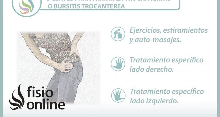 3 claves para tratar la trocanteritis o bursitis trocantérea
