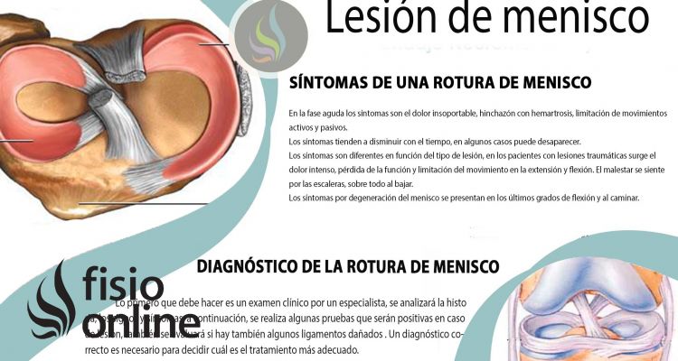 Lesión y rotura de Menisco: Consejos y tratamiento fisioterapéutico Lesión y rotura de Menisco: Consejos y tratamiento fisioterapéutico