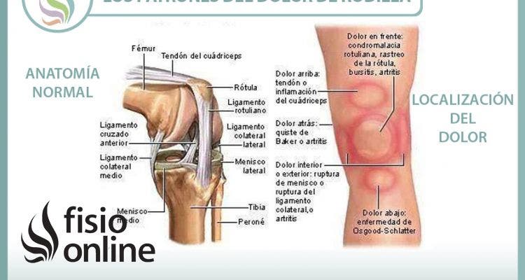 Los patrones del dolor de rodilla o gonalgia y las lesiones más comunes