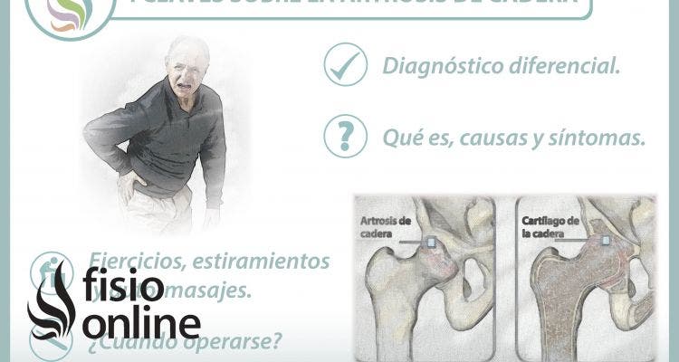 4 claves sobre la artrosis de cadera