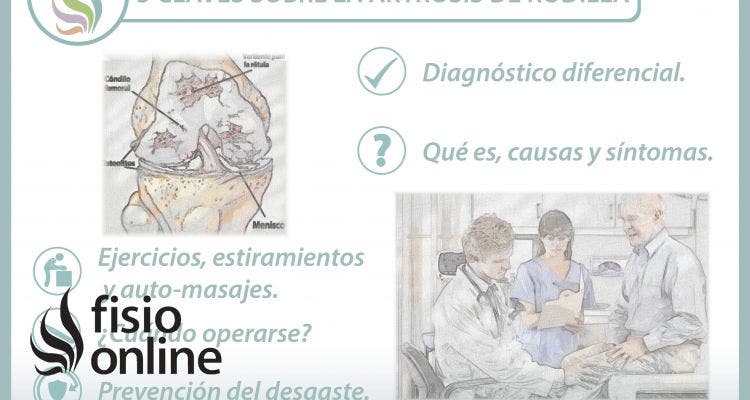 5 claves sobre la artrosis de rodilla