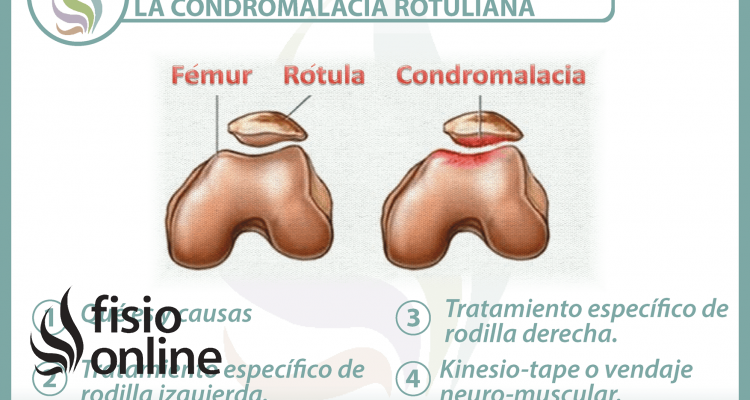 4 claves para entender y tratar la condromalacia rotuliana