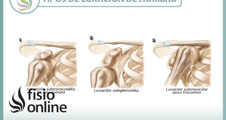 Luxación de hombro. Qué es y cuales son sus tipos