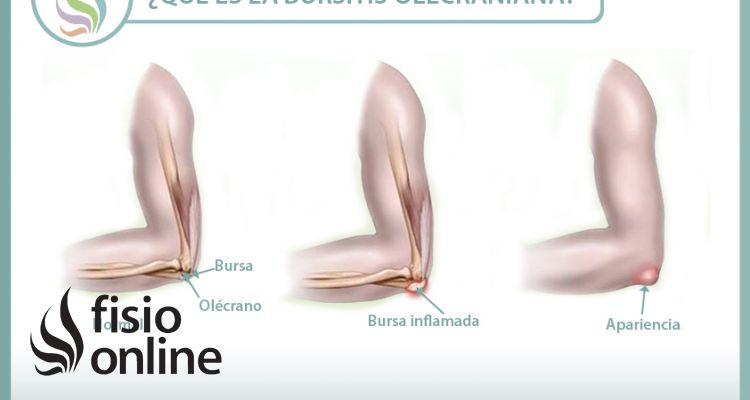 Descubriendo la bursitis olecraniana