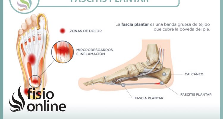 Fascitis plantar. Qué es, cuáles son sus causas y cómo podemos tratarla Fascitis plantar. Qué es, cuáles son sus causas y cómo podemos tratarla