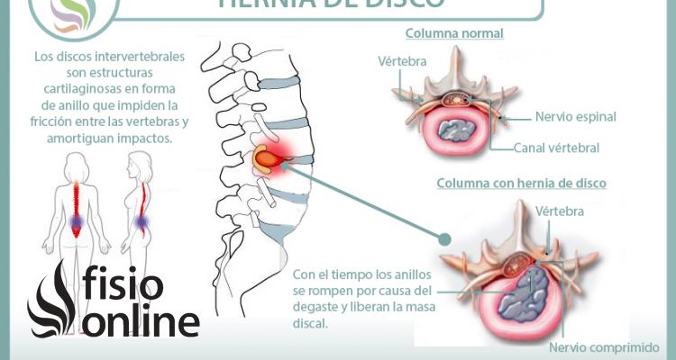 Conoce todo lo que necesitas saber sobre las hernias de disco, causas, consecuencias, síntomas y tratamiento desde la fisioterapia Conoce todo lo que necesitas saber sobre las hernias de disco, causas, consecuencias, síntomas y tratamiento desde la fisioterapia