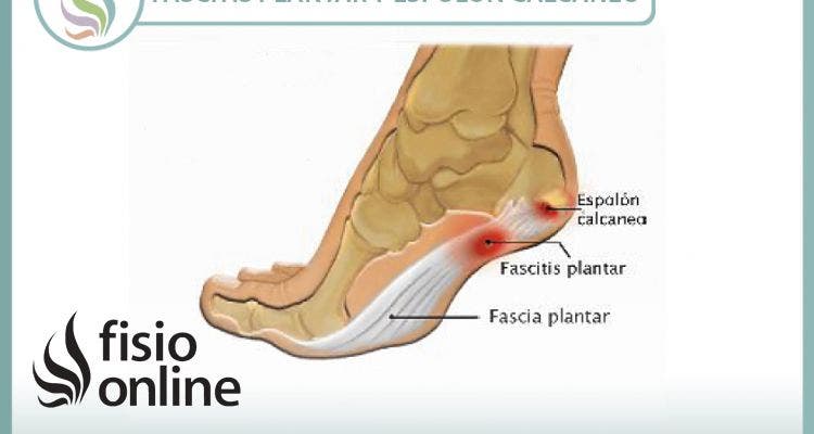 Fascitis plantar y espolón calcáneo, aprende lo que es y como se trata correctamente