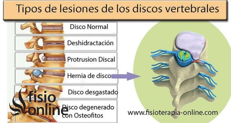Las vértebras cervicales suelen sufrir lesiones, una de ellas es la hernia discal cervical descubre como y porque ocurre