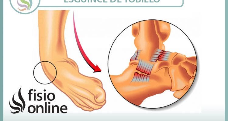 Esguince o torcedura de tobillo - 29 vídeos sobre esta lesión