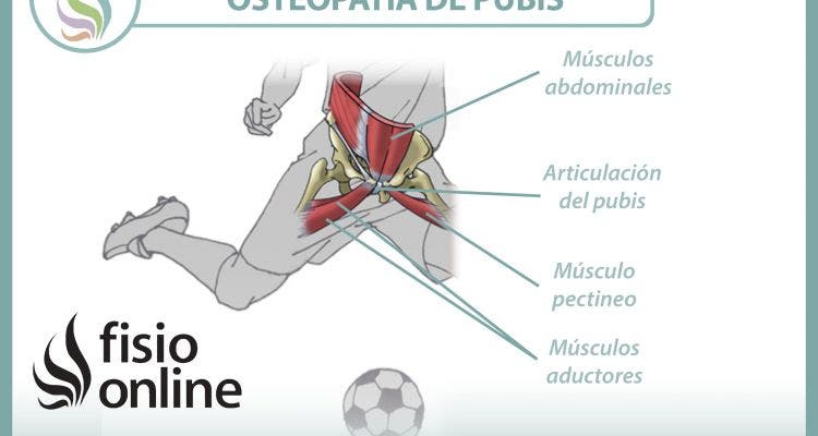 Entendiendo la osteopatía de pubis o pubalgia del futbolista