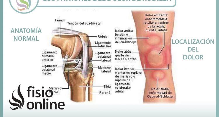 Los patrones del dolor de rodilla o gonalgia y las lesiones más comunes