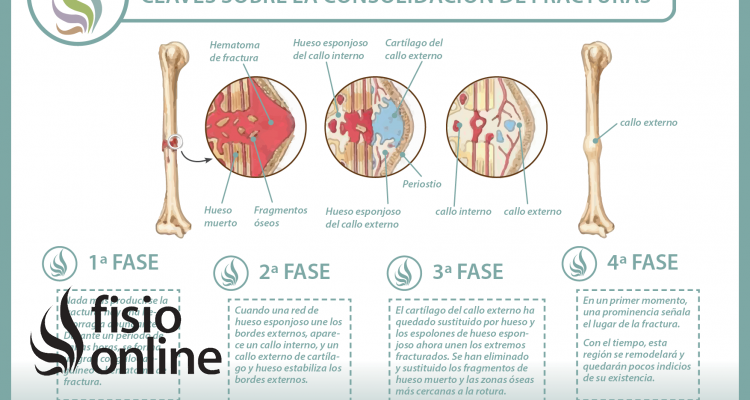 ¿Sabes cómo se consolidan o recuperan las fracturas de huesos? Descubre cómo ocurre