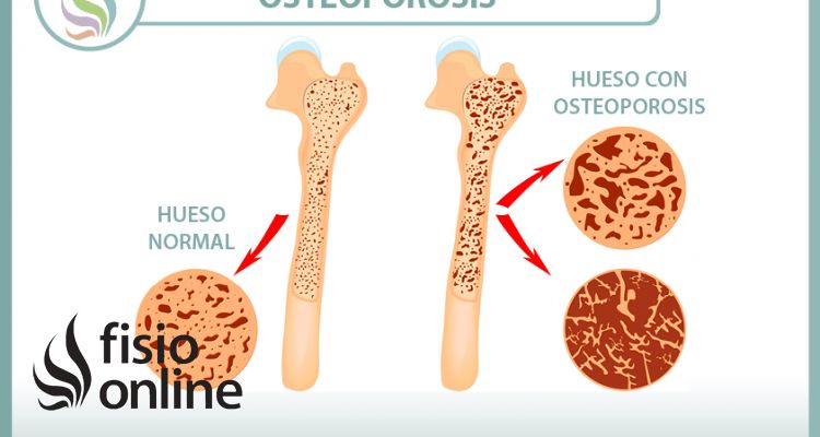 Explicando la osteoporosis Explicando la osteoporosis