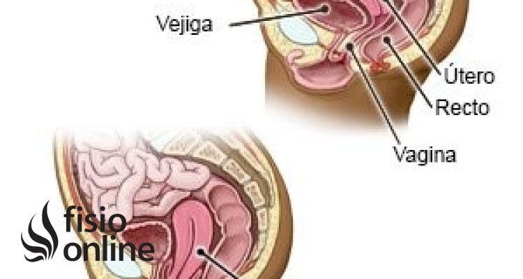 Prolapso uterino y vesical