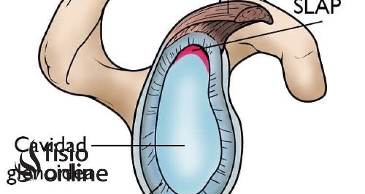 Lesión de SLAP