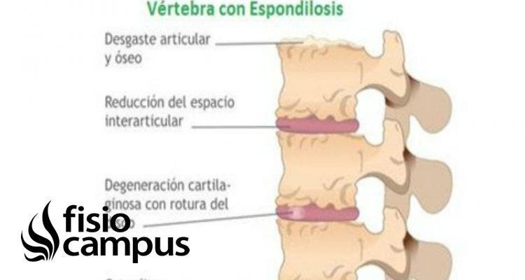 espondilosis