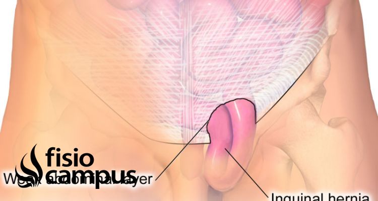 Hernia Inguinal Que Es Que Estructuras Afecta Sintomas Signos Clinicos Causas Y Tratamiento Fisioterapeutico