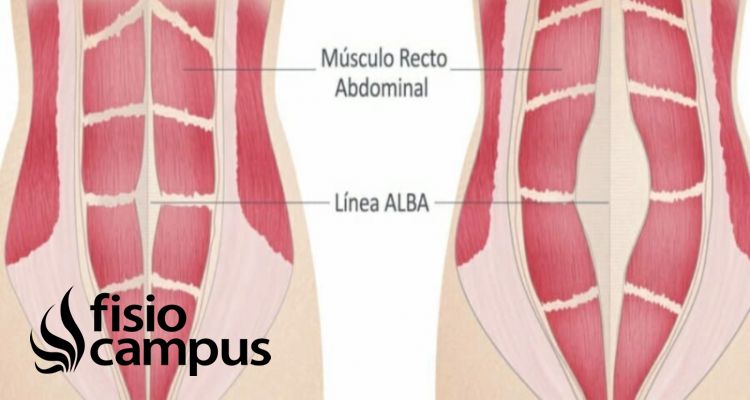 Recto Abdominal Que Es Como Estirar Y Fortalecer Origen Insercion Inervacion Y Diastasis Abdominal