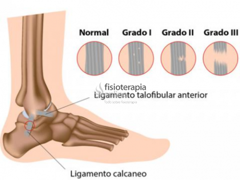 Esguince de grado 3: hay una rotura completa de la porción ligamentosa.
