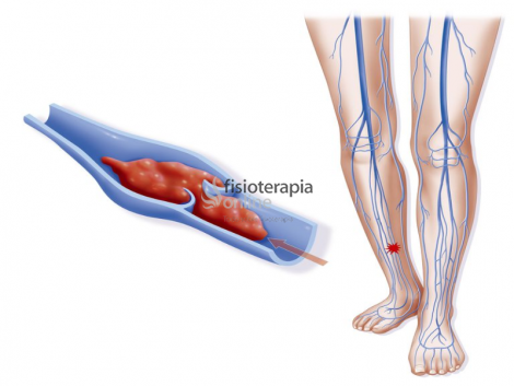Flebitis