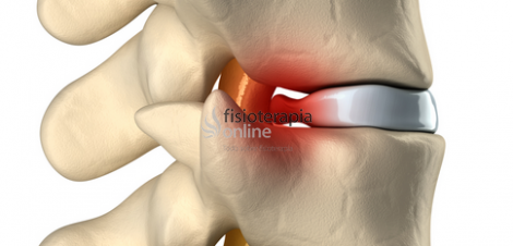 Tratamiento De Hernia Discal Cervical Fisioonline