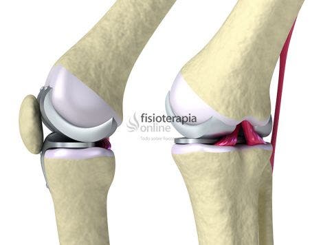 Efectos prehabilitación postoperatoria en pacientes artroplastia total  rodilla - Ecufis - Cursos presenciales y online para Fisioterapeutas