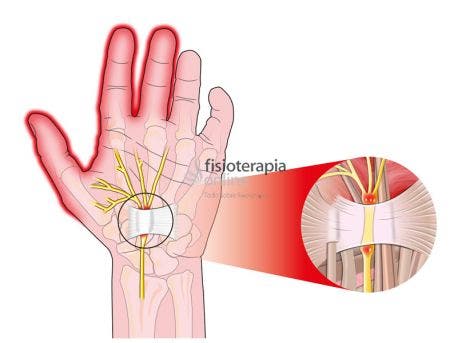 Tratamiento para el túnel carpiano - Clínica de Fisioterapia en Alcalá -  Fisio And Therapies