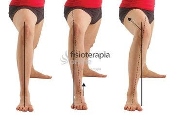 Caso de repuesto Necesito Valgo de Rodilla, Qué es y cual es su tratamiento o corrección | FisioOnline Caso de repuesto Necesito Valgo de Rodilla, Qué es y cual es su tratamiento o corrección | FisioOnline