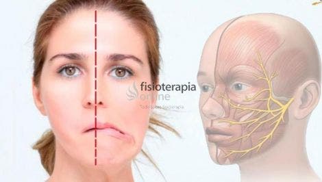 Masajes para paralisis facial izquierdo clearance