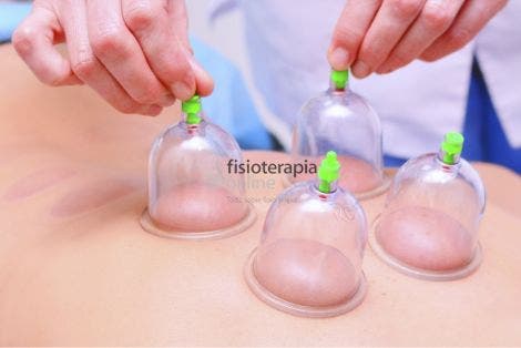 Qu es el Cupping Therapy Ventosas para que sirve y como