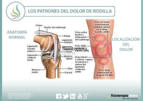 Los Patrones Del Dolor De Rodilla O Gonalgia Y Las Lesiones Mas Comunes Fisioonline