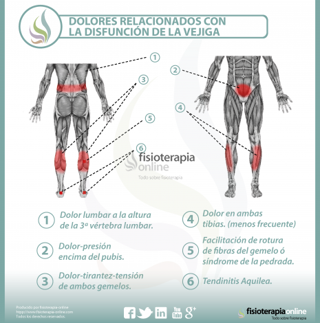 ¿Cómo puedo saber si tengo ciática?