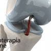 Ligamento cruzado anterior. Tratamiento de fisioterapia inicial y ejercicios en casa tras intervención quirúrgica.