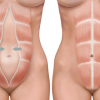 Diástasis de los rectos abdominales. Qué es y consejos para su cuidado