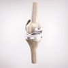 Lo que debes saber sobre las prótesis de rodilla