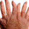 ¿Se puede curar la artrosis?