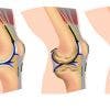 Artrosis o desgaste articular. Qué es, causas, síntomas y tratamiento quirúrgico y de fisioterapia