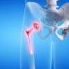 Cirugía de Protesis de cadera, Cómo se realiza la operación y cómo es su rehabilitación