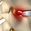 Tratamiento de hernia discal cervical  