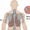 ¿Cómo se pueden disminuir las complicaciones ocasionadas por las fracturas de costillas?