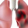 Enfermedad pulmonar obstructiva cronica o EPOC ¿Qué es?