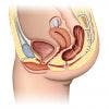 ¿Qué es la Incontinencia urinaria? ¿Cómo se trata?
