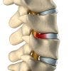 Hernia discal central a nivel L5-S. Causas, síntomas y tratamiento en fisioterapia