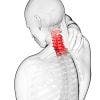 Artrosis cervical o Cervicoartrosis. Causas, síntomas y tratamiento